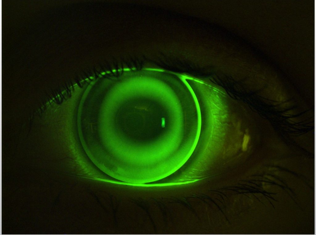 Auge mit Ortho-K-Linse unter fluoreszierendem Licht